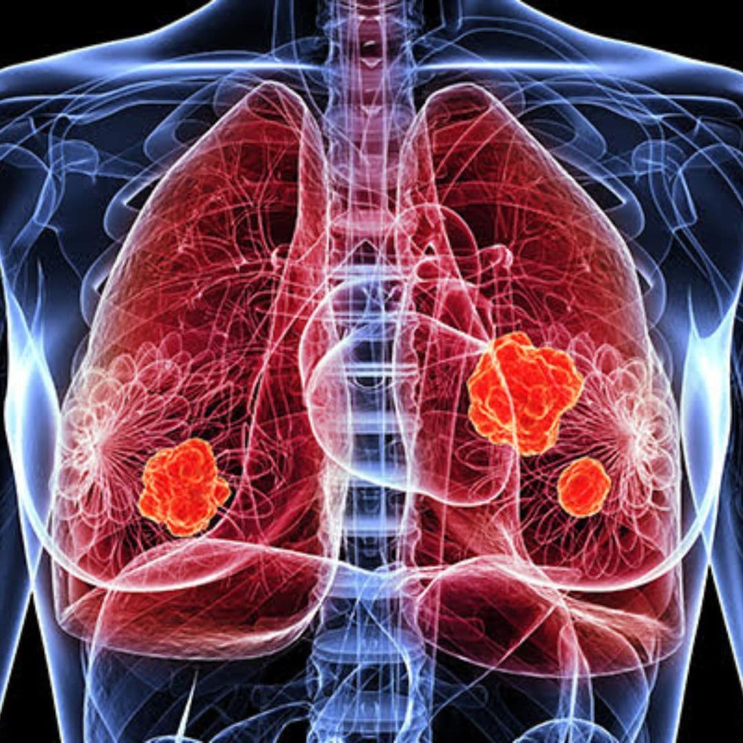 Diagnosis Guide for Lung Cancer
